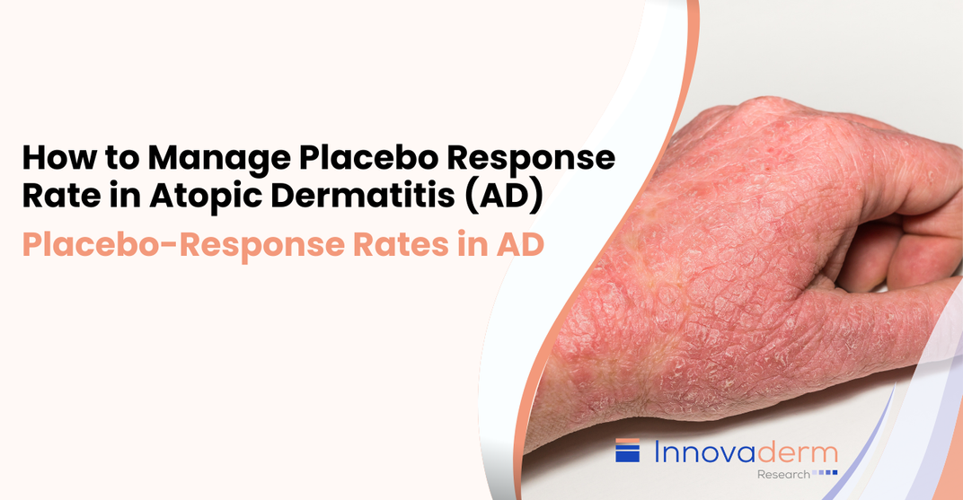 How to Manage Placebo Response Rate in Atopic Dermatitis